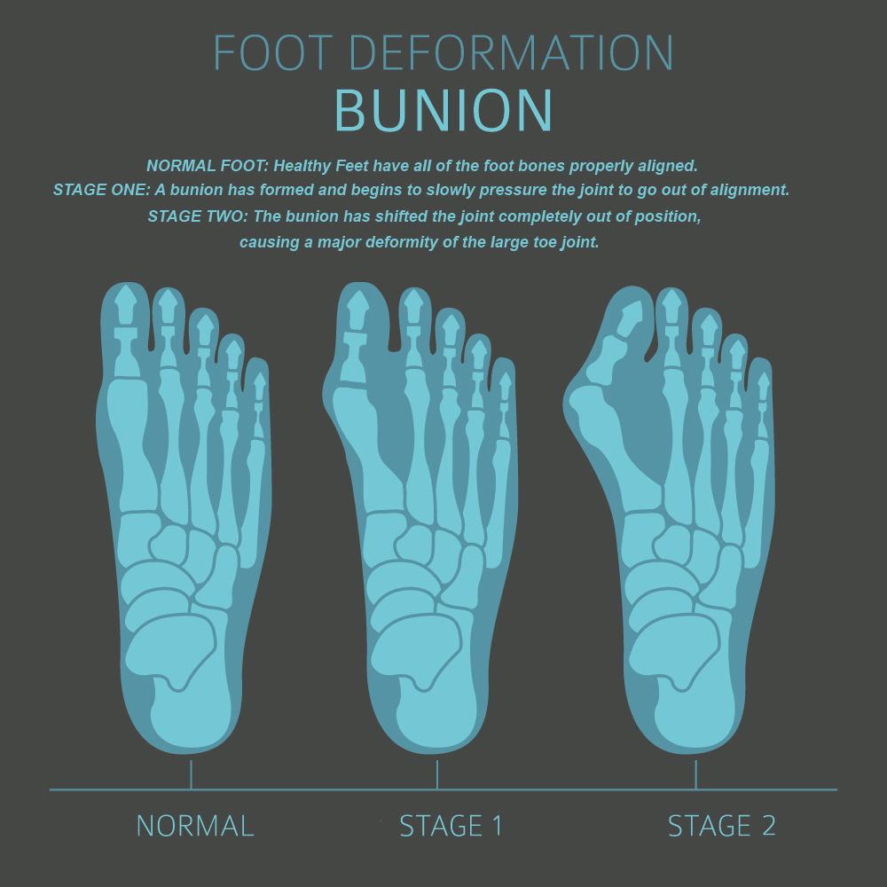 Foot Anatomy BUnion
