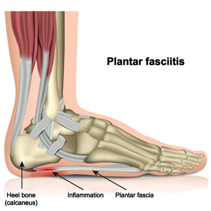 white sandals for plantar fasciitis