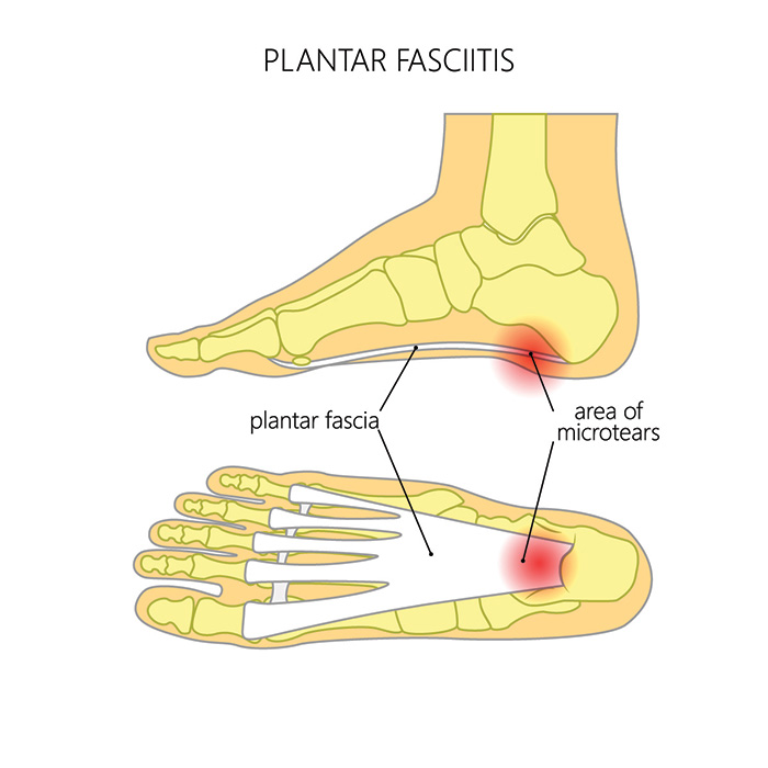 Behind Your Heel Pain: Washington Foot & Ankle Sports Medicine: Podiatry